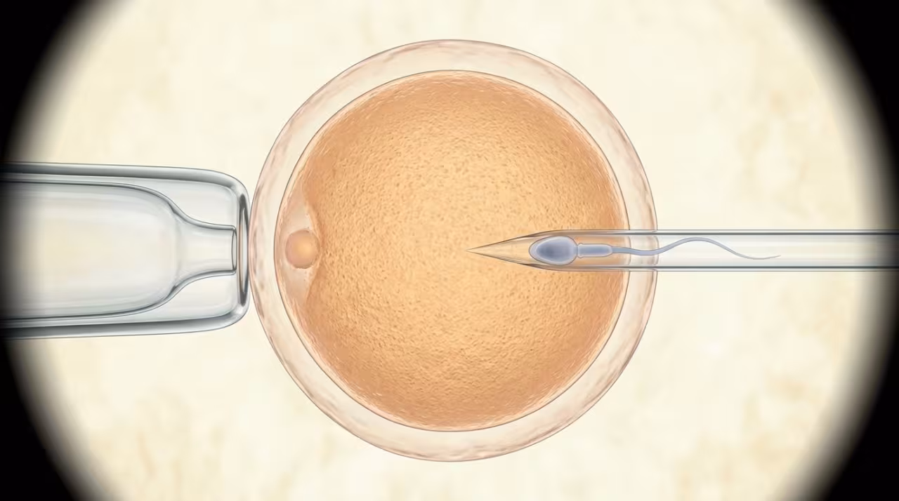 Intracytoplasmic Sperm Injection (ICSI)